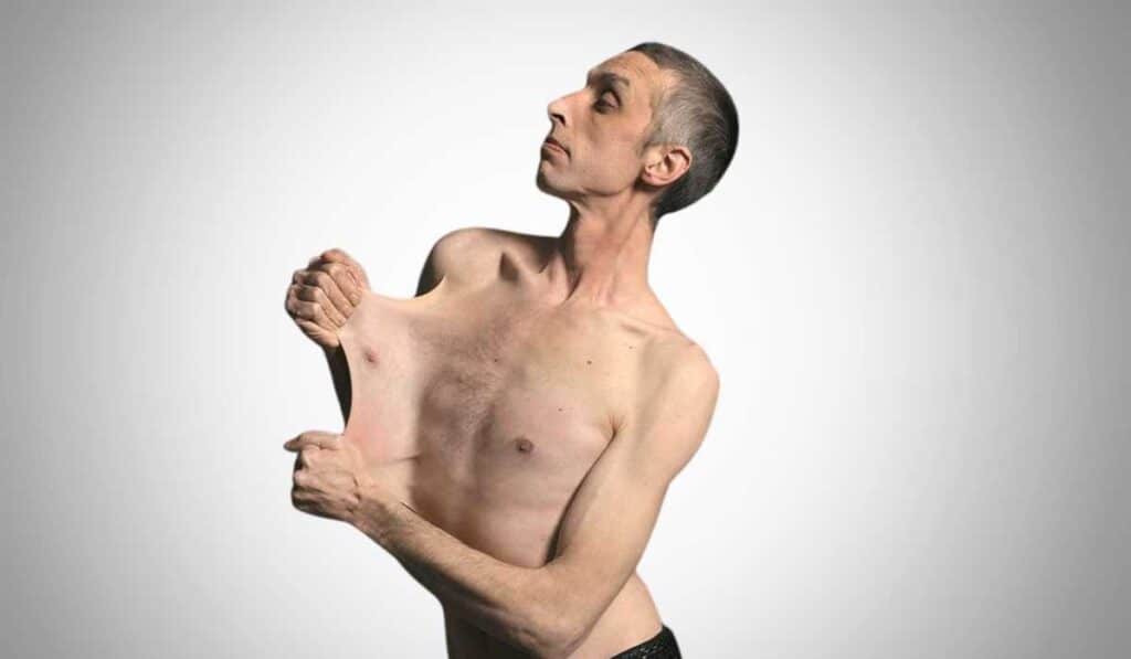 Stretchiest skin in the world - weirdest world record